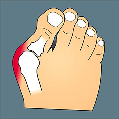 Hallux Valgus bone