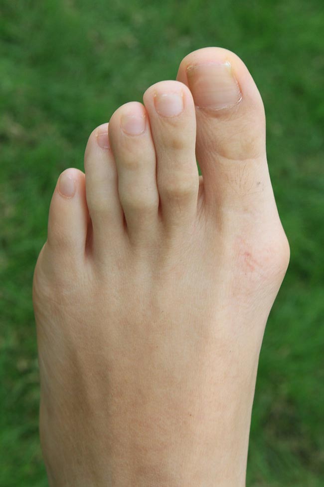 Hallux Valgus foot