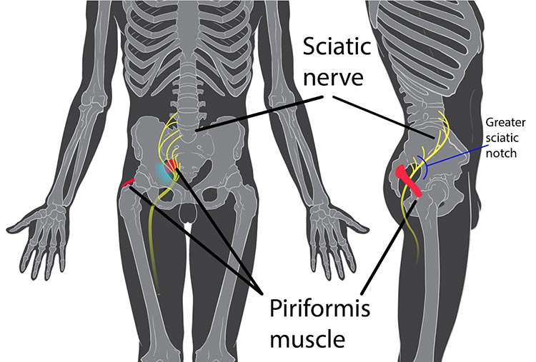 Išijas vs. piriformis sindrom